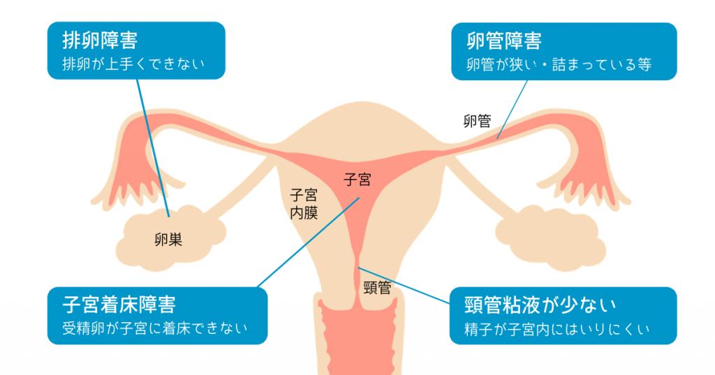 女性の不妊原因