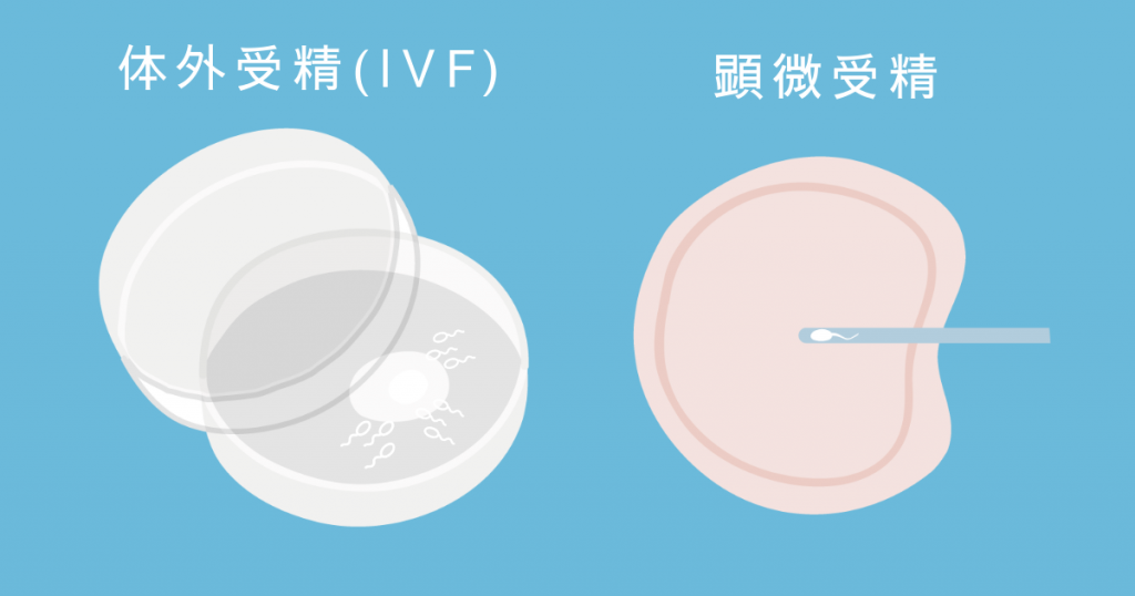 体外受精の方法や費用